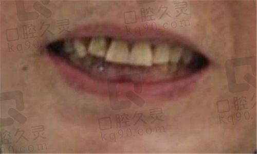 武汉清华阳光口腔种植牙记录分享：带老人种牙真的不错