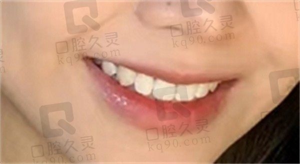 上海瑞欧齿科（漕宝路店)矫牙多少钱，分享亲历金属托槽牙齿矫正全程真的很用心