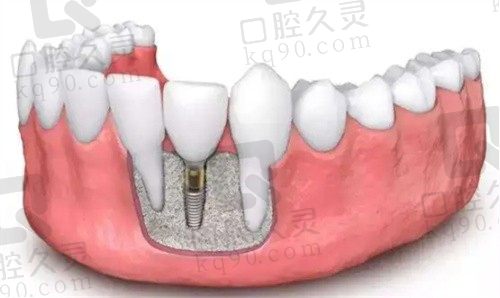 布莱梅口腔医院免费种牙是真的，半口/全口种牙有优惠