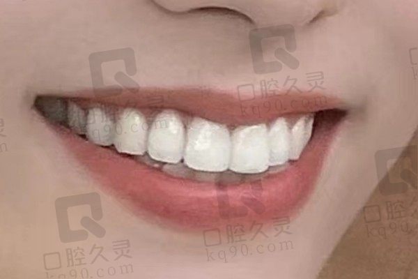 上海奉浦医院口腔科怎么样？看我做的全瓷牙贴面对比就知道