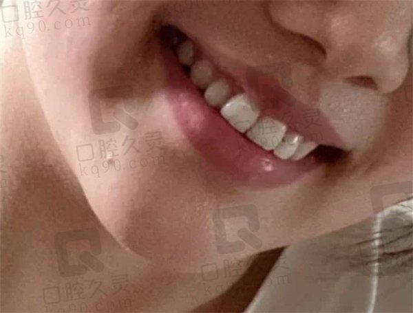 上海松井口腔矫正牙两年，摘掉牙套牙齿整齐了、侧颜也美了