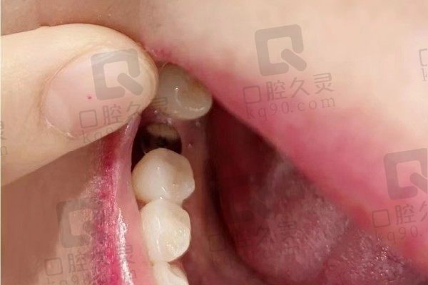 上海沈莹浩口腔诊所怎么样？分享种牙两年后真实感受与评价