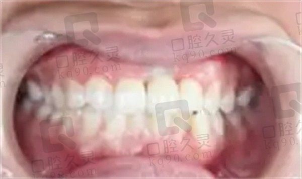 上海明珠医院口腔科种植牙怎么样，给你一份韩国登腾种植牙结果请查收