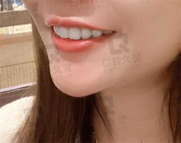 上海鹏翔口腔让我明白30做矫正牙一点都不晚,牙齿矫正后变化真的很美
