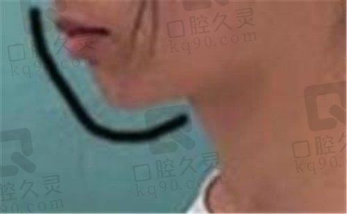 30岁在北京世纪城口腔矫正牙很成功，9个月金属自锁矫正龅牙内收了5mm