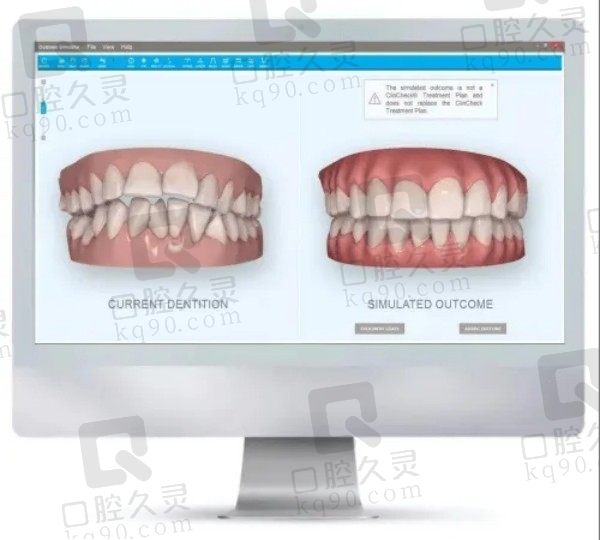 数字化正畸是什么意思？解析和传统正畸的区别含费用多少钱