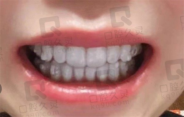 北京瑞泰口腔医院矫牙技术佳，从网友分享隐适美牙齿矫正经历中得知