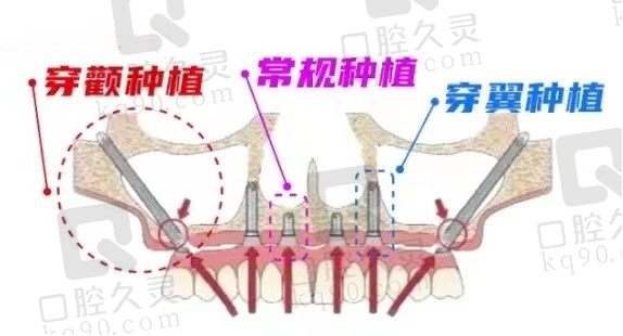 科普穿颧穿翼种植技术是个啥？什么医院可以做种植失败率高吗