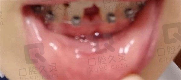 北京仁爱口腔矫牙怎么样，分享牙友治疗过程和就医感受