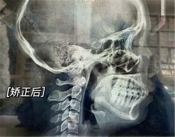 北京康贝佳口腔38岁大龄人矫正牙经历分享，原来年龄大正畸也是有用的