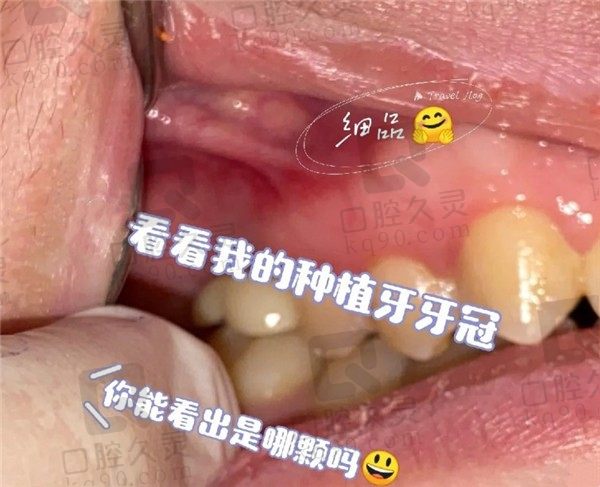 北京劲松口腔种植牙过程舒适，种的牙不仅好还美观