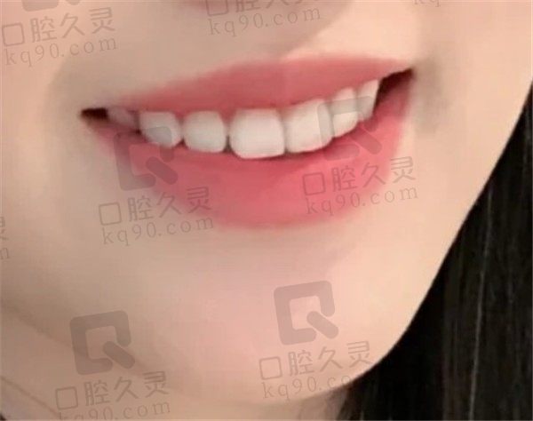 牙缝大一定要做牙齿矫正吗,不妨看看我在北京冠美平乐口腔做的全瓷贴面