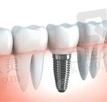 长沙中诺口腔种牙多少钱？美国进口种植牙5000/颗送牙冠