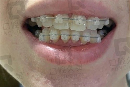 北京中鸿口腔矫正牙1个月我真的后悔了,牙齿矫正真的不能在30岁做