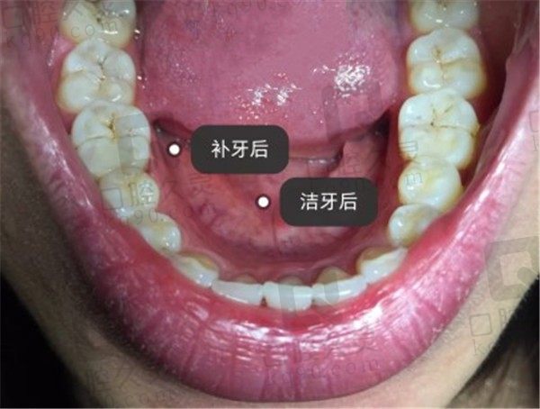 北京齿康口腔补牙+洁牙经历分享，补牙不疼还美观