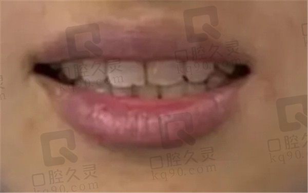 北京雅德嘉口腔医院牙齿矫正怎么样，网友在线更新隐适美隐形矫正全过程