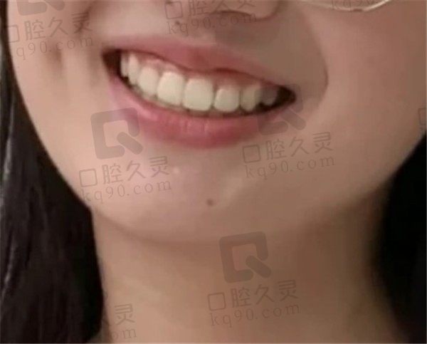 上海沈莹浩口腔矫正牙3年，排齐牙齿的同时变美了