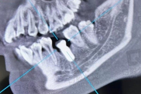 想知道上海尤旦口腔种牙怎么样多少钱？请看我的种植牙经历