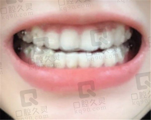 上海美奥口腔我的矫正牙初体验分享，做的牙齿矫正容貌不再焦虑