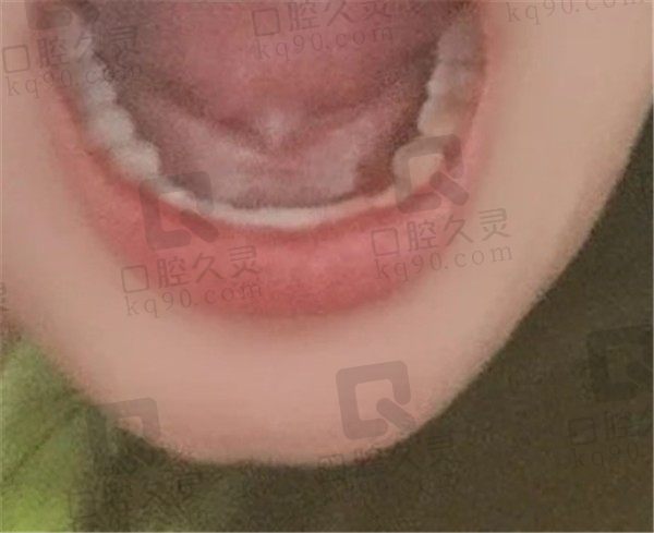谁说年龄小不能种牙了，18岁的我在上海瑞伢美口腔种的牙已使用半年了