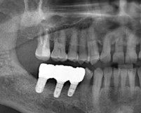 我在太原恒伦口腔种植牙的全过程告诉你：太原恒伦口腔种牙怎么样？