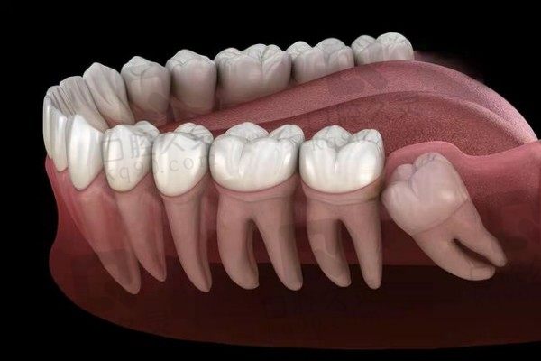 智齿有几种类型大科普！快来看看哪种智齿难拔价格多少钱一颗