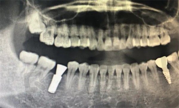 宿迁大众牙科种植牙怎么样，据说网友瑞典诺贝尔种牙经历很赞