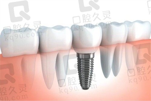 问金华做种植牙多少钱一颗？本文附2023年进口种植牙价格