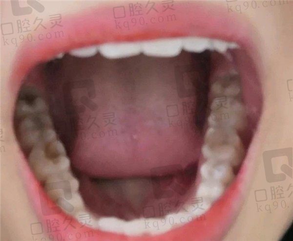 上海补牙我信赖上海佳泸口腔，根管治疗+补牙感觉我的牙从没坏过