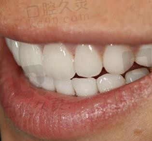金华华康口腔医院到院洗牙体验分享：黄牙变白是一点都不难