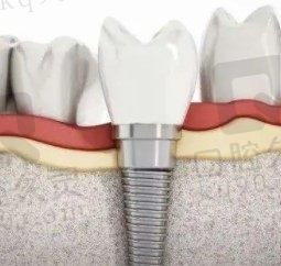 种植牙脱落了怎么办，脱落的种植体能不能再次使用