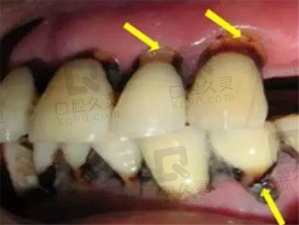 老年人龋齿怎么办，4种缓解、治疗方法已公布