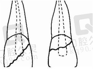 牙折断了神经外漏怎么办，能不能补好？