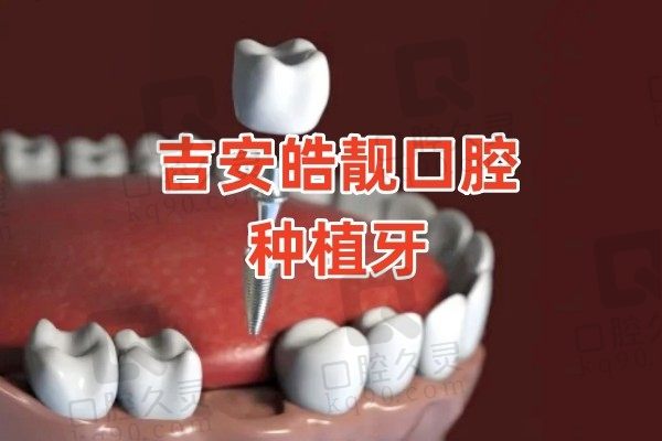 奉上吉安皓靓口腔种牙价格表！美国皓圣种植牙仅4980元起