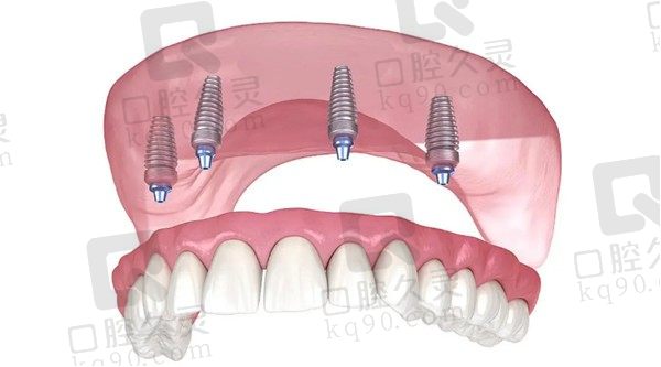 allon4种植牙是覆盖义齿吗？了解下什么是allon4种植