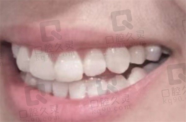 郑州固乐口腔种植牙很正规，在线更新我的瑞士ITI种植经历