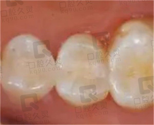 北京煤医龋齿治疗真赞，我在北京煤医修复的5颗龋齿和真的一样