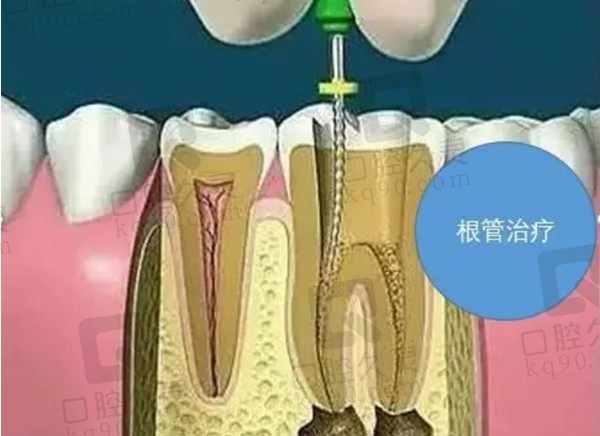 根管治疗的费用大概要多少钱？在医院做根管治疗能报销吗？