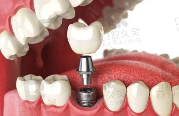 整合种植牙患者评论区,有40-50岁患者谈种植牙10年后的感受