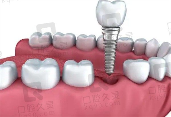 镶牙和种植牙有什么区别哪个好，镶牙多少钱一颗2023年