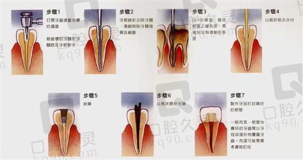 前牙根管治疗后必须做牙冠吗，前牙根管治疗后可以正常使用吗