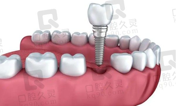 通辽种植牙多少钱2023价格表，公布单颗/半口/全口种牙价格