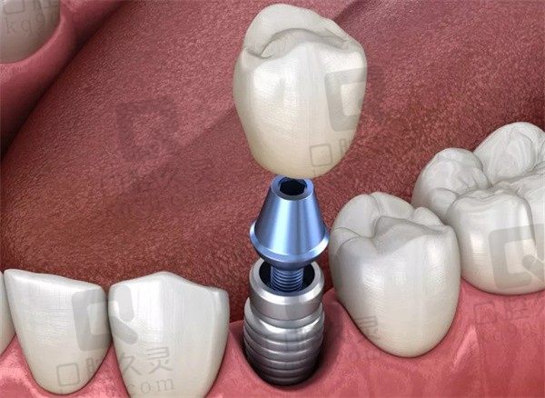 合肥种植牙多少钱一颗2023年，排名靠前的这几家正规又便宜