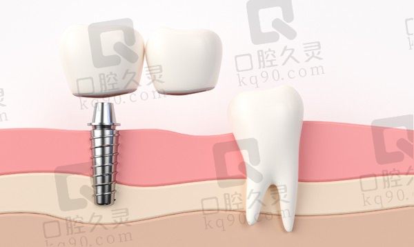 2023池州种植牙多少钱？单颗2980元起/半口3w+