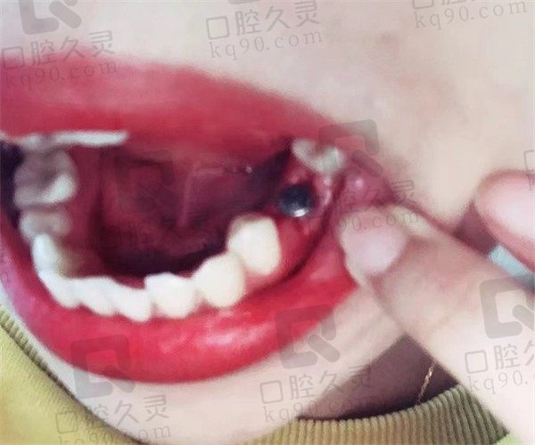 郑州中诺口腔种植牙技术高超你敢信，分享我德国种植牙全过程
