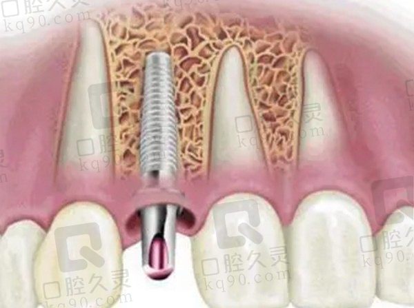 威海种植牙多少钱一颗2023年？附排名前三口腔医院种植牙价格表
