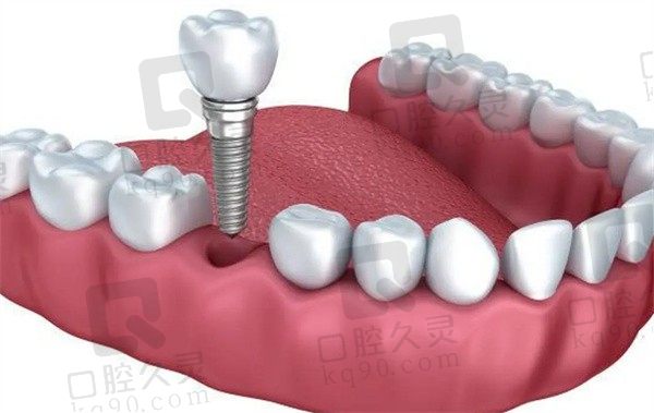 拔牙之后立马种牙好吗，新锐种植牙技术体验感真的很赞