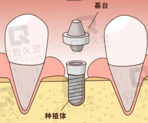 北京斯迈尔口腔种植牙技术很靠谱，韩国登腾种植牙仅需3980元