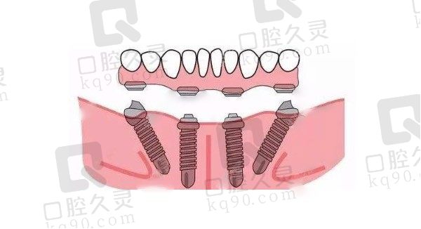 allon4种植牙是什么意思，allon4种植牙的风险有多大！