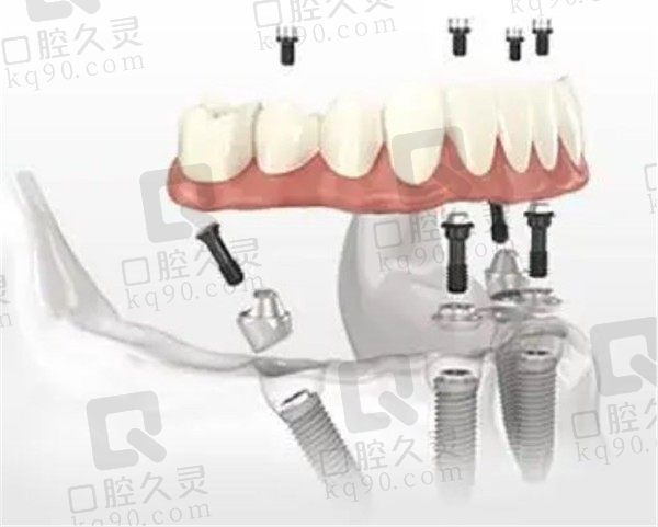 国内满口种植牙大概多少钱，北京/上海/广州老人满口种植牙价格已更新